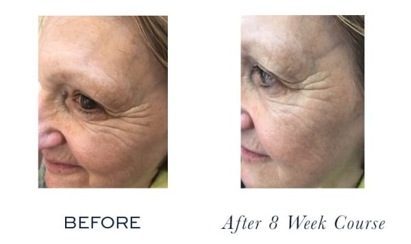 Firm-a-Lift Course ~ dramatically lifted and much firmer