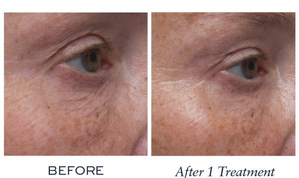 Hydrated skin with reduced fine lines and wrinkles