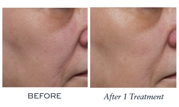 Significantly increased skin smoothness and improved skin tone
